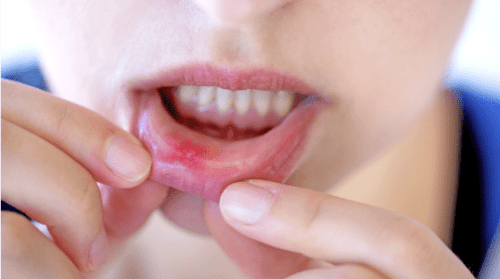 Mida teha, kui suhu tekkis vill? Apteeker jagab kasulikke nõuandeid