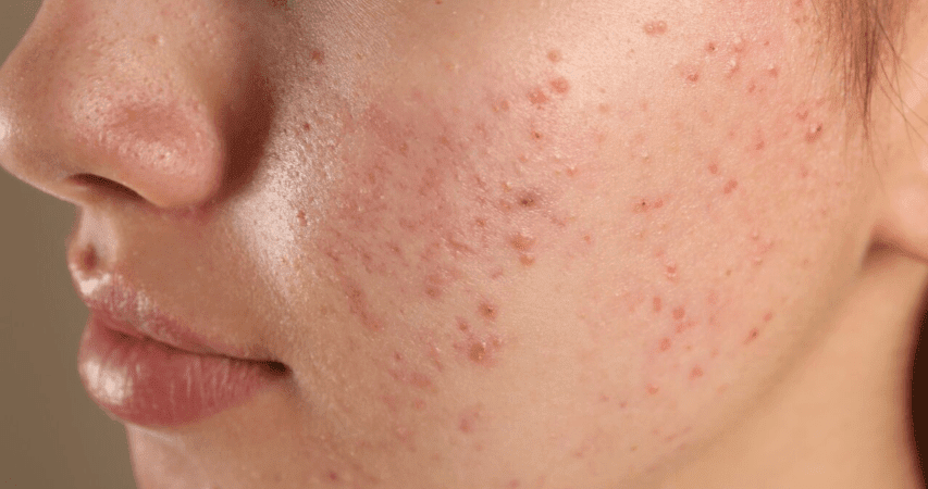 Akne on jälle tagasi? Spetsialist: mida kiiremini abi otsitakse, seda parem